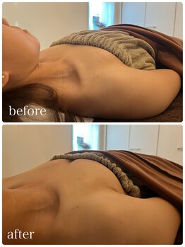 リノ 行橋(lino)/◇バストアップ症例◇20代