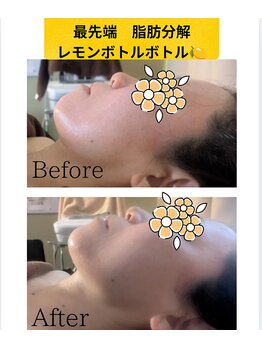 ポノ(pono)/最先端★脂肪分解×WINBACK