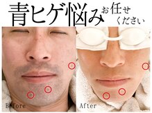 スポット 薬院駅前店(SPOT)/#脱毛 #ヒゲ脱毛 #毛 #SHR #IPL