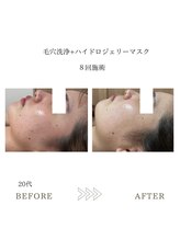 サロンエイトミー 西船橋店(salon 83)/【毛穴洗浄】before→after☆