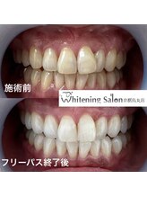 ホワイトニングサロン 京都烏丸店/ホワイトニング施術例