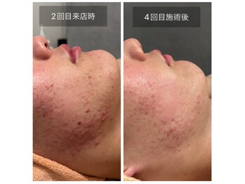 スムース(smooth)/フェイシャル：クリスタルパック