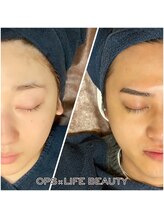 オプス ライフビューティー(OPS×LIFE BEAUTY)/ブライダル脱毛