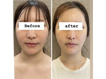 アリィ(Alii)/浮腫なしの別人級の顔になる