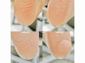 ニコプラス 大橋店(NICO+)/足裏角質除去