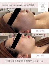 リバース(Rebirth)/脂肪燃焼小顔コース