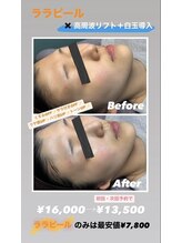 ミミロンビューティー(Mimiron Beauty)/爆発的人気LHAピーリング