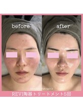 スピカ(Spica)/話題のREVI陶器トリートメント！