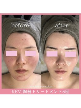 スピカ(Spica)/話題のREVI陶器トリートメント!