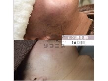 ソフニスの雰囲気（当店で脱毛をされたお客様の変化の記録です。顔ヒゲ全体脱毛16回）