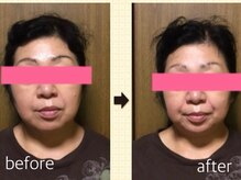 アップル マリー 江別/■小顔矯正