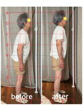 スイレン 西新宿(SUIREN)/施術1回でのbefore/after