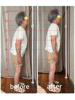 スイレン 西新宿(SUIREN)/施術1回でのbefore/after