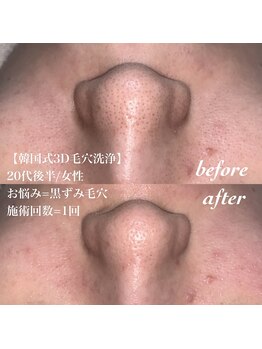 サロン ド カスケード(Salon de Cascade)/韓国式3D毛穴洗浄