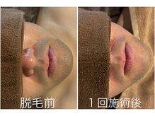 オアシスサカエ(OASIS SAKAE)/【髭脱毛】１回の施術、2週間後