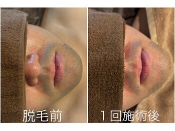 オアシスサカエ(OASIS SAKAE)/【髭脱毛】1回の施術、2週間後