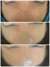 ジュエルビューティー(Jewel Beauty)/ダクトピール2回目