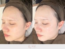 ルーミー 南青山(LUME)/くすみ／乾燥