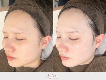 ルーミー 南青山(LUME)/くすみ／乾燥