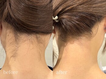 アン フェミン(une FEMIN)/【うなじwax】渋谷/眉毛/脱毛wax