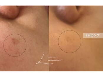 リュール(Lueur)の写真/シミ、増えていませんか？流行に左右されない本格シミケア◎紫外線に負けない明るい印象の肌へ♪
