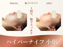 痩身専門店エステティックサロン コクア(KOKUA)の雰囲気（【ハイパーナイフ】お顔の脂肪分解＆老廃物スッキリ流す！）