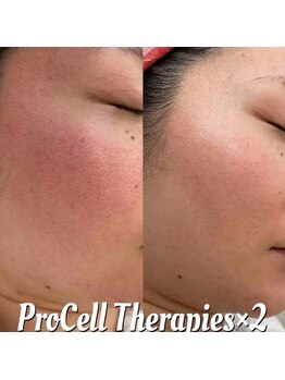 アリアンド(ari.and)/肌質改善プロセルフェイシャル