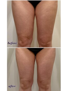 メンズアンドレディース エステティックサロン ティアラ(TiaLa)/太ももサイズダウン