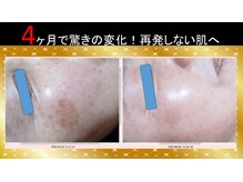 ビューティークリニーク アマーレ(Amare)/シミケア　ターンオーバー復活