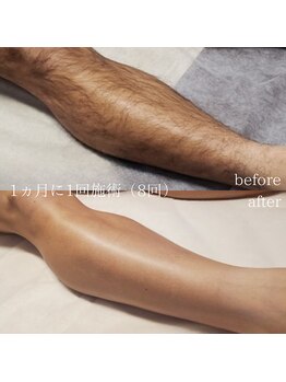 アール(ar.)/両あし脱毛（8回）