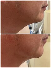 テセラ(Tethere)/高周波サーモ×脂肪分解剤