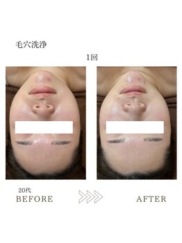 サロンエイトミー 西船橋店(salon 83)/【毛穴洗浄】before→after☆