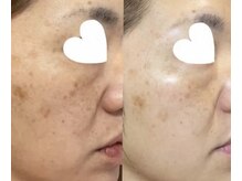 リセラージュ(Recellage)/【よもぎ蒸し】乳菌美人蒸し