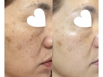 リセラージュ(Recellage)/【よもぎ蒸し】乳菌美人蒸し