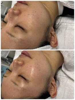 オカオビューティー 枚方市駅前南口店(okao beauty)/毛穴洗浄