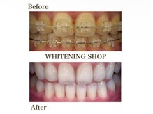 ホワイトニングショップ 米子店の雰囲気（矯正中でもホワイトニング可能です。）