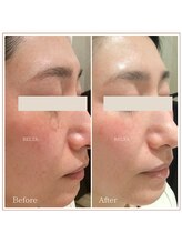 ベルタ(BELTA)/ケア前→3ヶ月後　シミ/たるみ