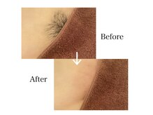 デリケートゾーン脱毛お任せください！一度で実感できます