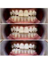 ティアラ 葛西店(TIARA)/セルフホワイトニングの効果実感