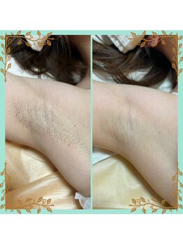 ネクサス(NEXUS)/ふと上げたときに気にならない脇