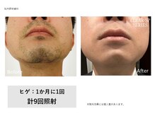 ユーセレクト ビューティー プラス(U-SELECT BEAUTY PLUS)/毎朝の髭剃りいらなくなります！