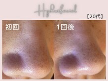 美シェリ(美Cheri)/ハイドラビフォーアフター