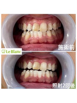 ルブラン 奈良店(Le Blanc)/効果あるホワイトニングで