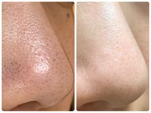 リテルナ(Re.terna)/■毛穴洗浄