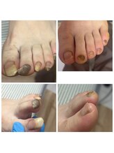 ドクターネイル爪革命 十条店/肥厚爪ケア