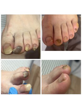 ドクターネイル爪革命 十条店/肥厚爪ケア