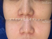 ロイ 初生店(LOI)/毛穴の黒ずみにさよなら！