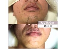 ソフニスの雰囲気（当店で脱毛をされたお客様の変化の記録です。顔ヒゲ全体脱毛13回）