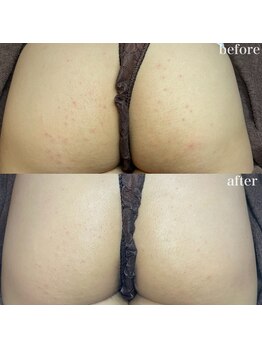 ちらちゅら/クリスティーナ【施術2回】経過