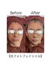 【女性限定シルバー割 50歳～】【光フォト 顔全体＋ SLB美容液導入¥9,000】
